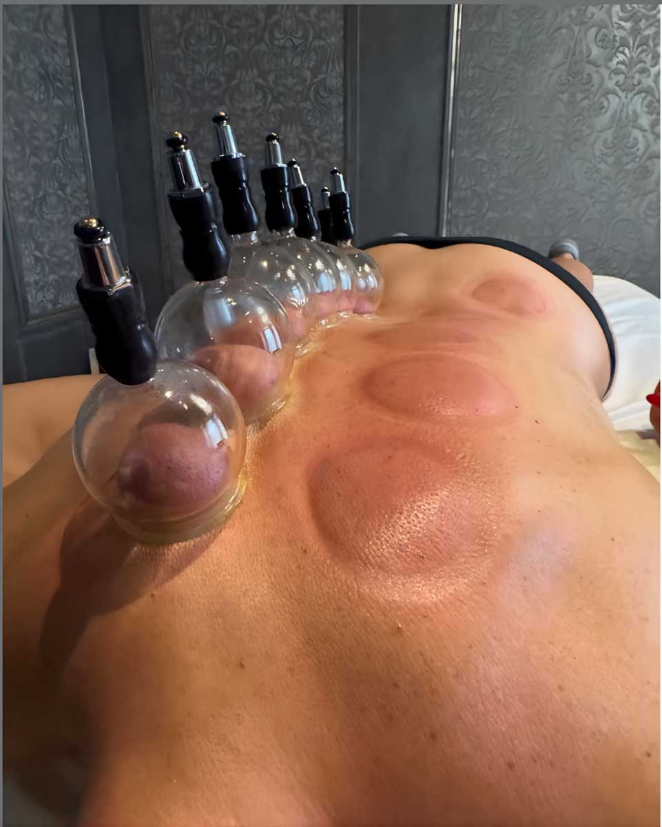 Osteopathy Services Cupping Therapy